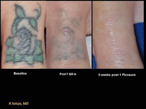 Clean slate tattoo removal - caqwesalsa