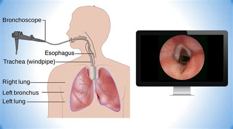 Bronchoscopy - Uses, Fiberoptic, Ebus, Rigid, Side Effects