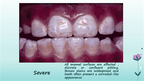 Dental Fluorosis