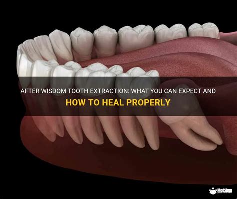 After Wisdom Tooth Extraction What You Can Expect And How To Heal Properly Medshun