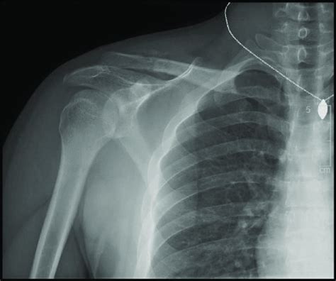 Six Week Postoperative Ap View Radiograph After Revision Surgery