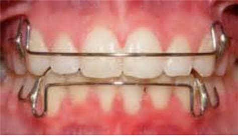 Orthodontic Appliances Flashcards Quizlet