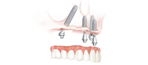 Pr Tesis Dental Fija Sobre Implantes Y Sobredentadura Sedi