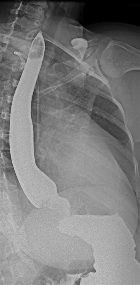 Gastric Cardia Cancer Invading The Distal Esophagus Barium Swallow Image