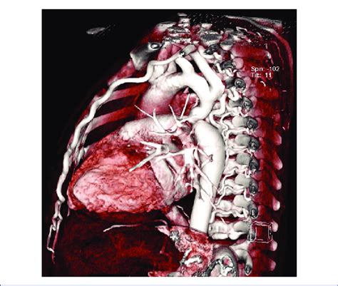 Ct With Volumetric Reconstruction Or 3d Sagittal Visualization Download Scientific Diagram