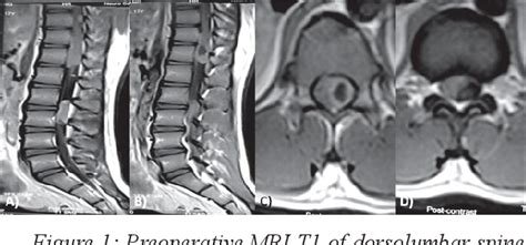 Figure 1 From Intramedullary Spinal Cord Ependymoma After Posterior