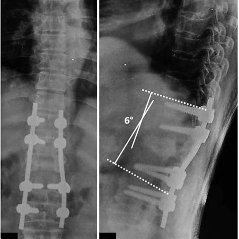 Standing Anteroposterior A And Lateral B Radiographs Of The