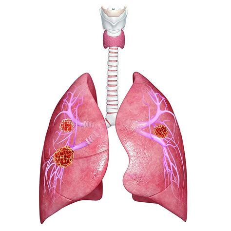 Lung Cancer Photograph By Pixologicstudio Science Photo Library Pixels