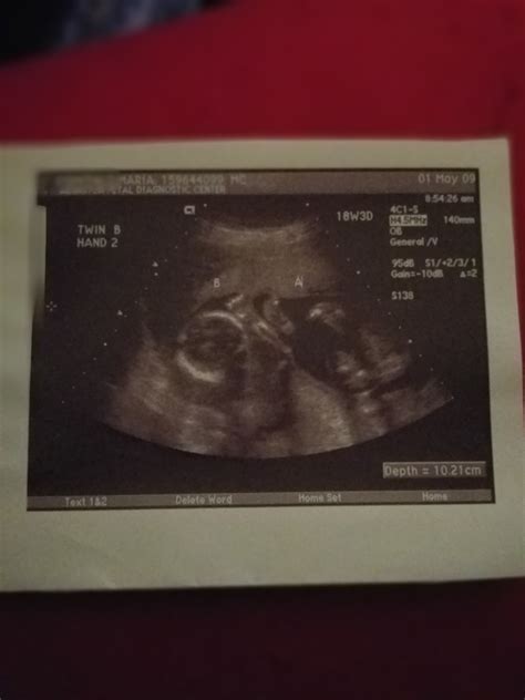 Fraternal Twins Ultrasound 18 Weeks