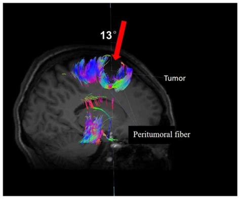 Application Of Diffusion Tensor Tractography In The Surgical Treatment