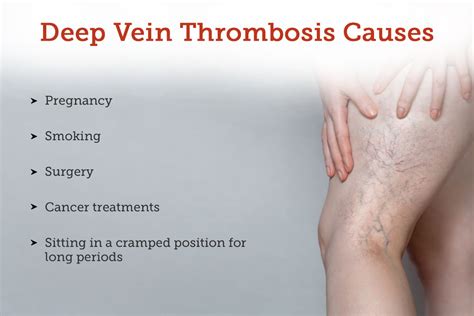 What Is Deep Vein Thrombosis Dvt Symptomstreatment 41 Off