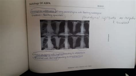 Allergic Bronchopulmonary Aspergillosis ABPA YouTube