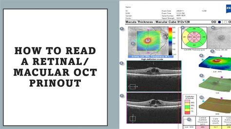 How To Read Macular Oct Printout Made Easy Youtube