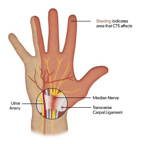 Carpal Tunnel: Hands-On! — Cedar South Chiropractic