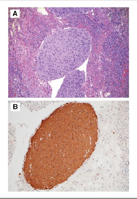 Figure From Ovarian Immature Teratoma With Gliomatosis Peritonei And