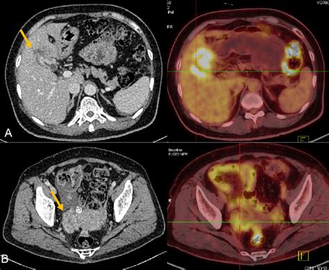 Figure 2 From Real Time Contrast Enhanced Ultrasound Guided