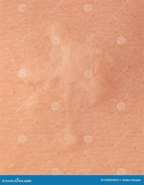 Scar On Human Skin After Heart Surgery Stock Image Image Of Wound