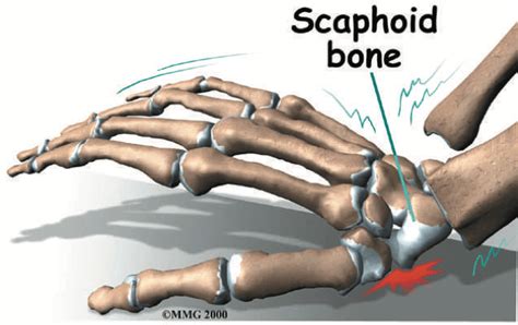 scaphoid - Edmonds Orthopedic Center