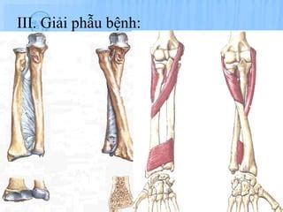 B gay pouteau û colle BỆNH NGOẠI KHOA PPT