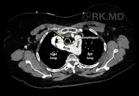 Double Aortic Arch | RK.MD