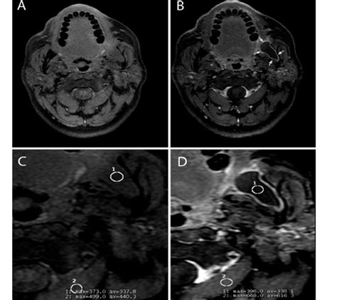 T1 Weighted Axial Images Fat Saturated Fast Spin Echo Ax T1 Fs FSE