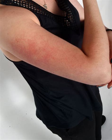 How To Get Rid Of Small Red Bumps At The Top Of Your Arms What Is The Condition Uk