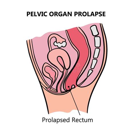 Prolapsed Rectum Of Women Medical Education Scheme Vector Set Stock