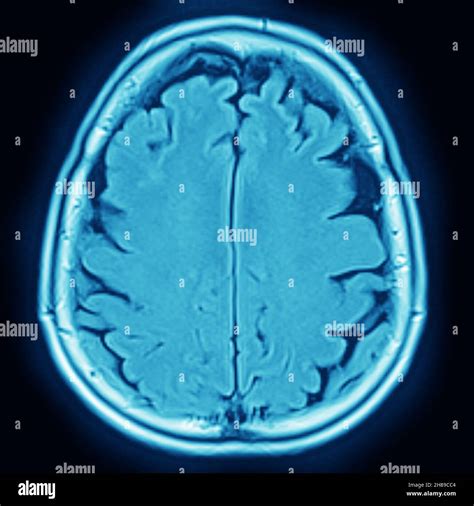 Mri Of Cerebral Atrophy Fotograf As E Im Genes De Alta Resoluci N Alamy