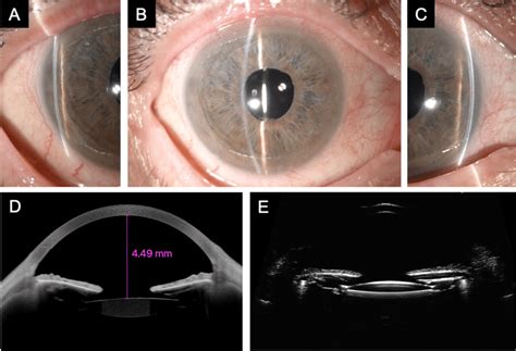 Anterior Segment Slit Lamp Biomicroscopy Of The Same Eye 12 Months Download Scientific Diagram