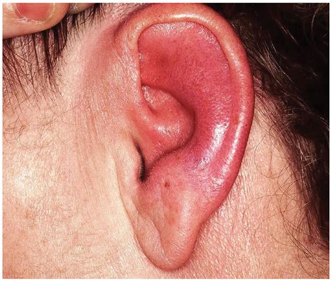 Seeing Redness And Ear Itation Clinician Reviews