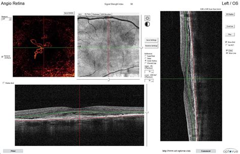 Optovue Angiovue Oct And Octa Imaging System Ophthalmicmart