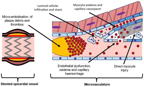 Microvascular Obstruction in Acute Myocardial I... 