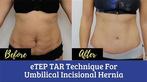 Best Hernia Surgery In Kolkata Etep Tar Technique For Umbilical