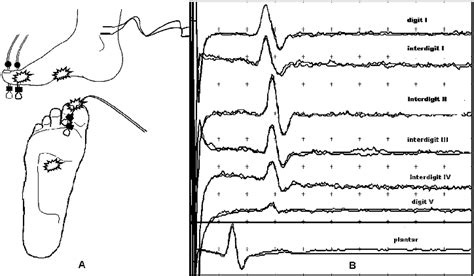 A Schematic Drawing Showing The Placement Of The Stimulating Bipolar Download Scientific