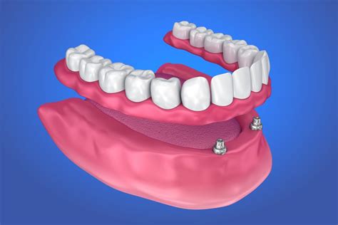 What is an Overdenture? - Bethesda Family Dentistry