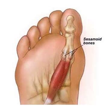 👉 Sesamoiditis - Treatment, Symptoms, Pictures, Causes, Surgery ...