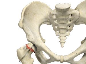 Slipped Capital Femoral Epiphysis Houston | Hip Pain Pearland | Hip ...