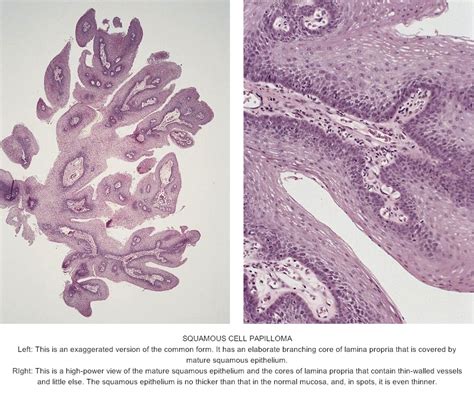 Pathology Outlines Squamous Papilloma Hot Sex Picture