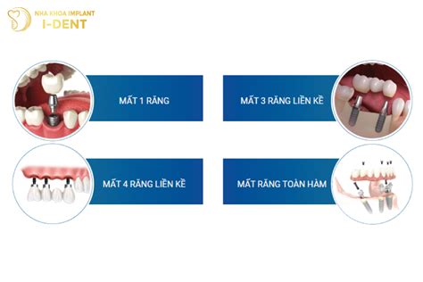 Cấy Ghép Implant Là Gì Tất Tần Tật Về Cấy Ghép Implant