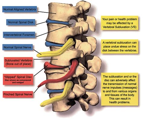 Subluxation - Chiropractic | Greenwood Spine Clinic