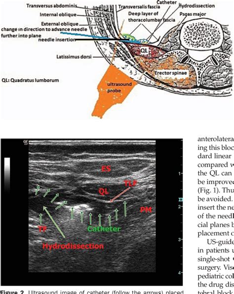 Ultrasound Guided Continuous Quadratus Lumborum Block For Postoperative