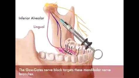 Técnica de Gow Gates para el Bloqueo del Nervio Mandibular YouTube