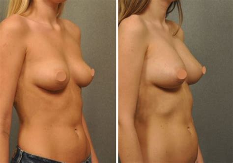 Natural Boob Job Breast Augmentation With Fat Grafting
