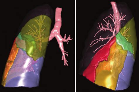 2 Left lung segmental anatomy created by software from a CT scan. A ...