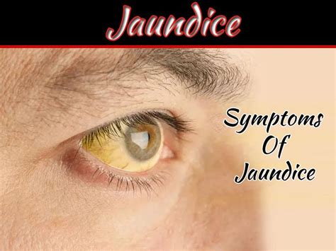 Causes And Symptoms Of Jaundice Jaundice Symptoms Symptoms Jaundice