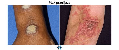 Psorijaza Simptomi I Uzroci Bio Plar Blog