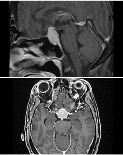 Spindle Cell Oncocytoma A Misdiagnosed Rare Entity Of The Pituitary