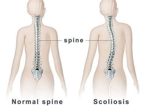 Skolyoz Omurga E Rili I Belirtileri Ve Tedavisi