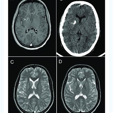 A Axial T1 Weighted Magnetic Resonance Mr Image Showing