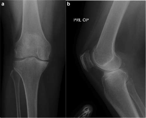 A Anteroposterior And B Lateral Radiograph Of Right Knee Indicated